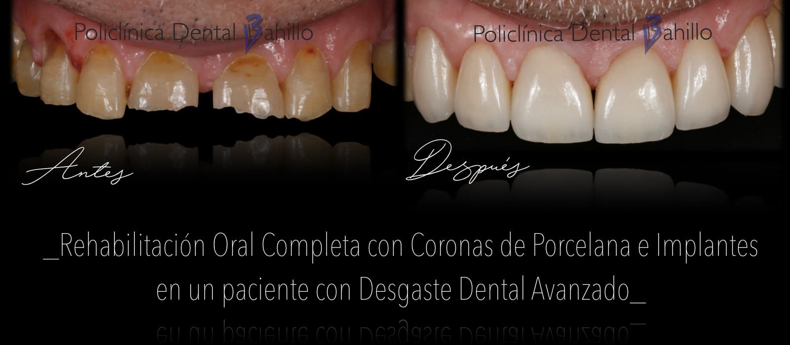 Rehabilitación completa - Policlínica Dental Bahillo