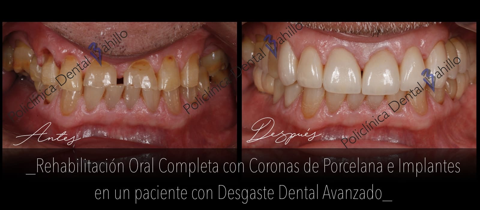 Rehabilitación completa - Policlínica Dental Bahillo