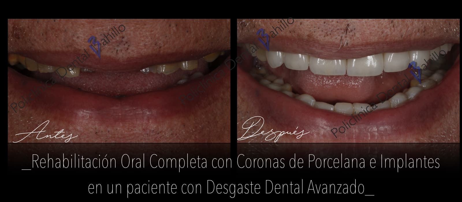 Rehabilitación completa - Policlínica Dental Bahillo
