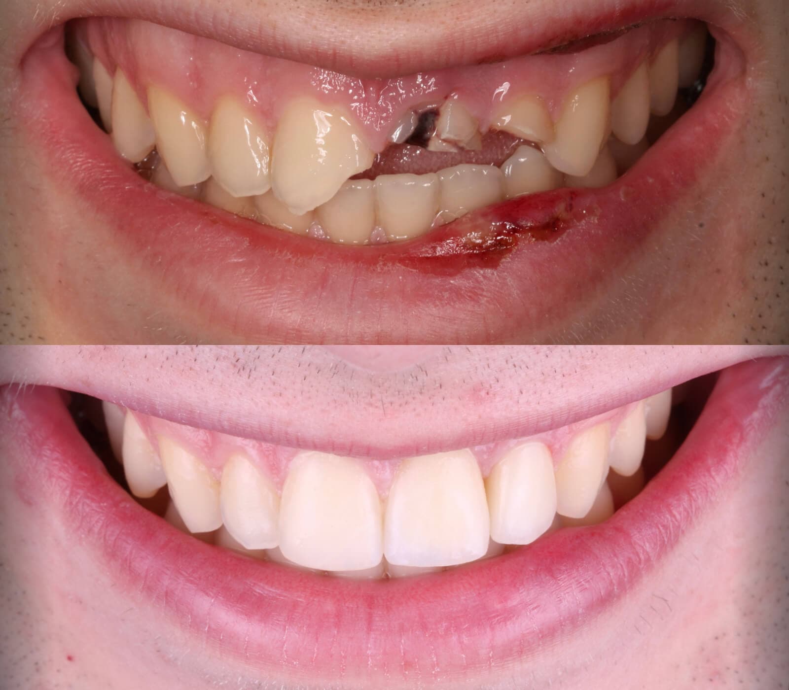Implantología dental en Santiago de Compostela