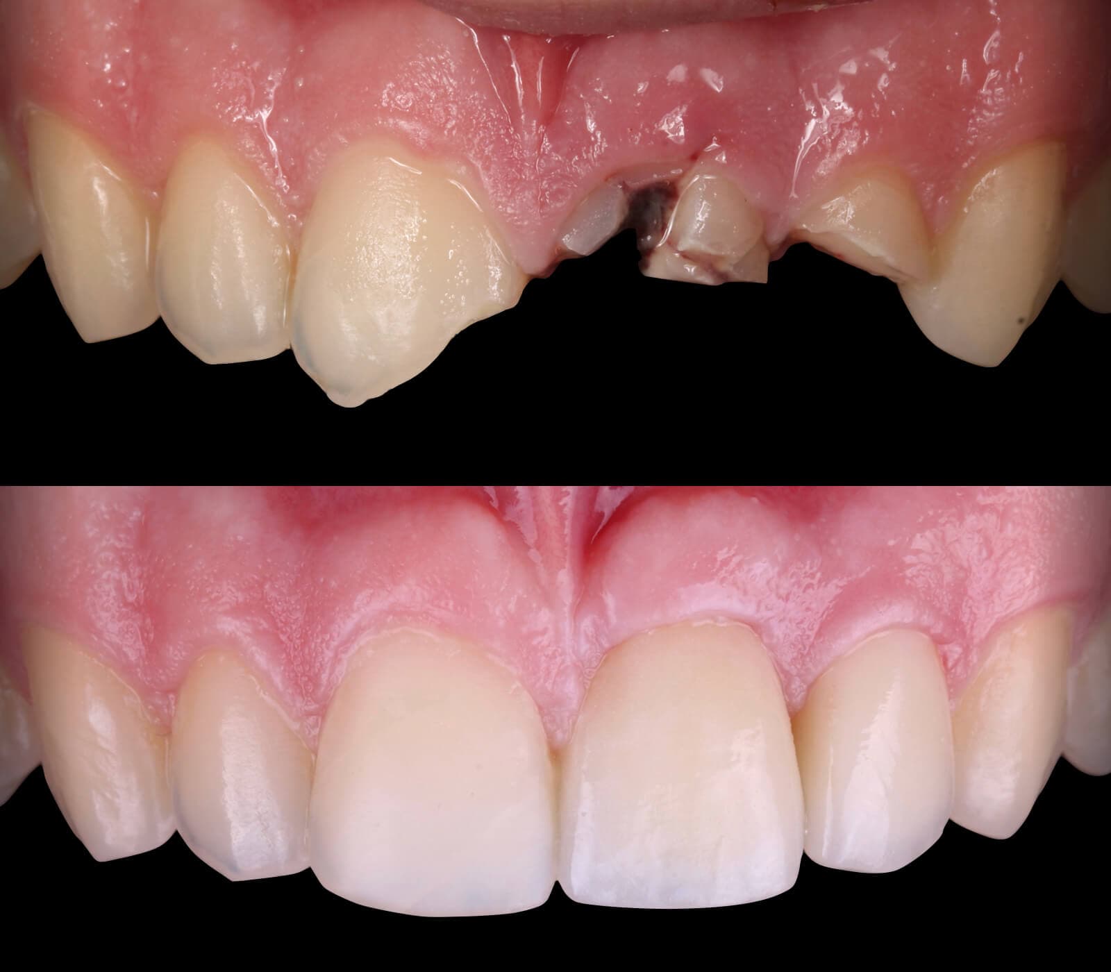 Implantes dentales en Santiago