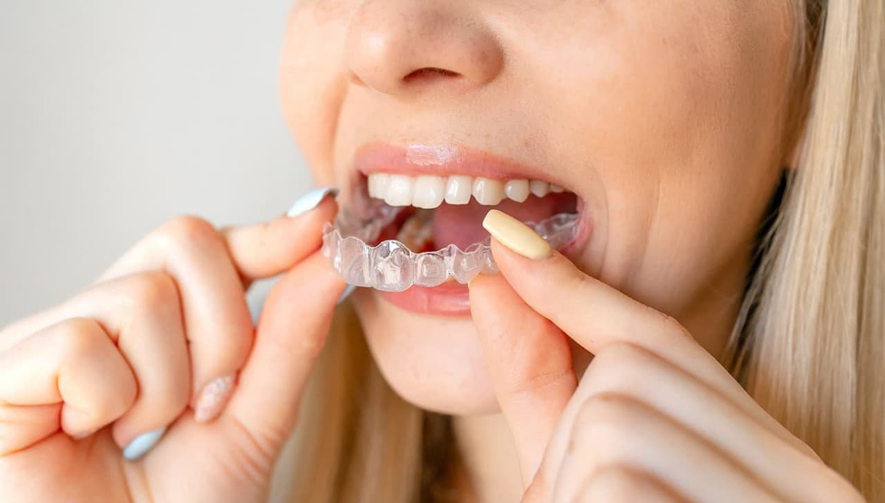 Ortodoncia invisible: Invisalign