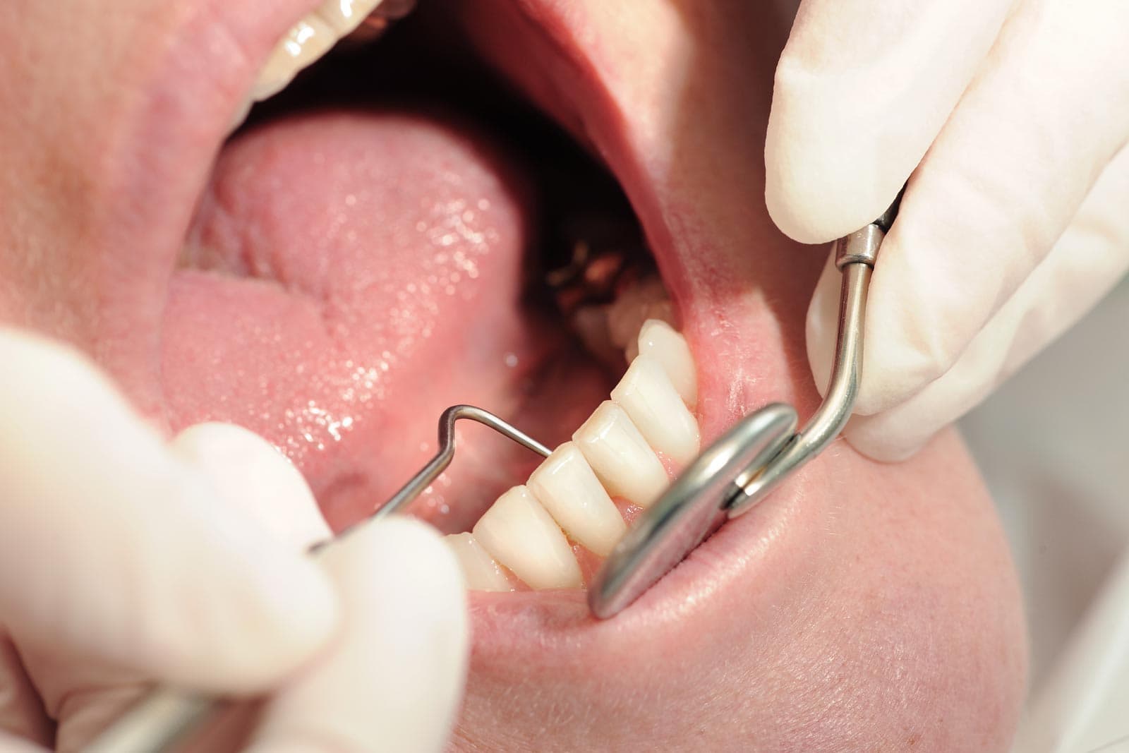 Tratamientos de periodontitis en Santiago de Compostela
