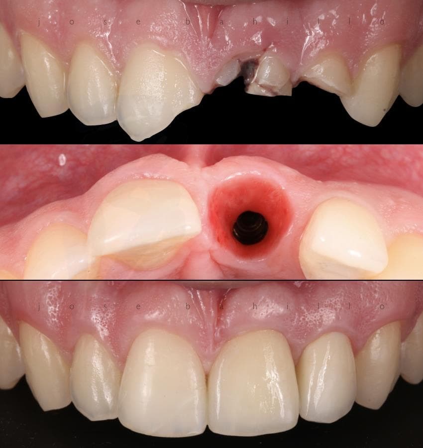 Implantes Dentales en Santiago de Compostela - Imagen 2