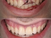 Implantes Dentales en Santiago de Compostela