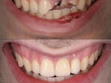 Implantes Dentales en Santiago de Compostela
