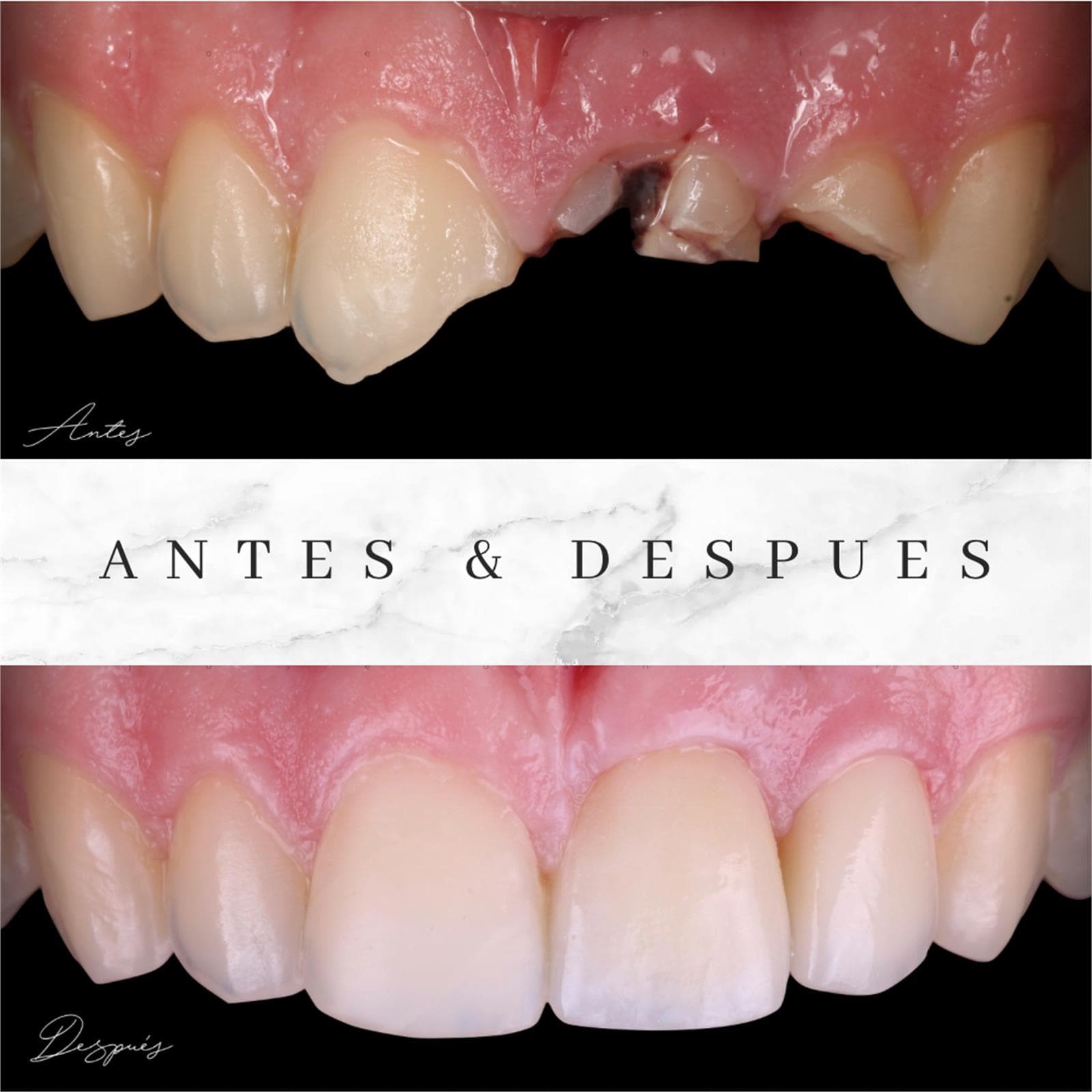 Implantes Dentales - Imagen 2