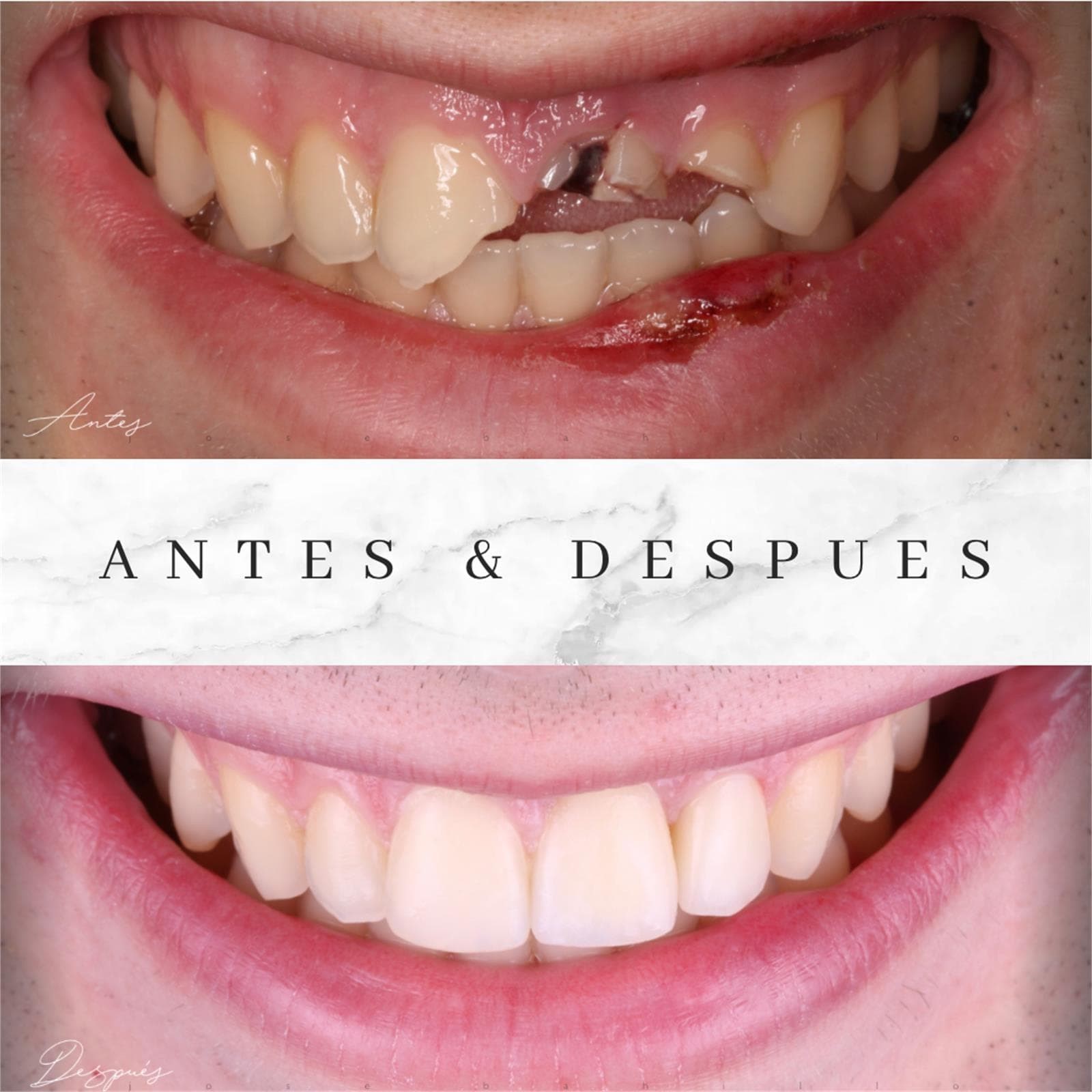 Implantes Dentales - Imagen 3