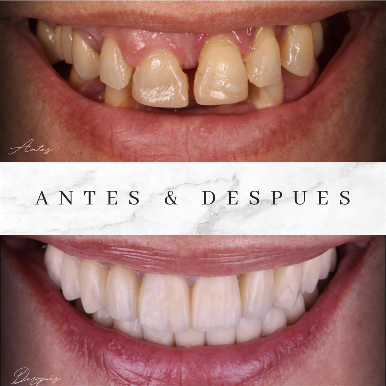 Implantes Dentales - Imagen 5