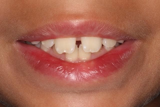 Ortodoncia Infantil - Imagen 2