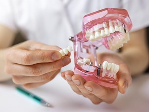 ¿Puedo ponerme un implante dental si tengo poco hueso?
