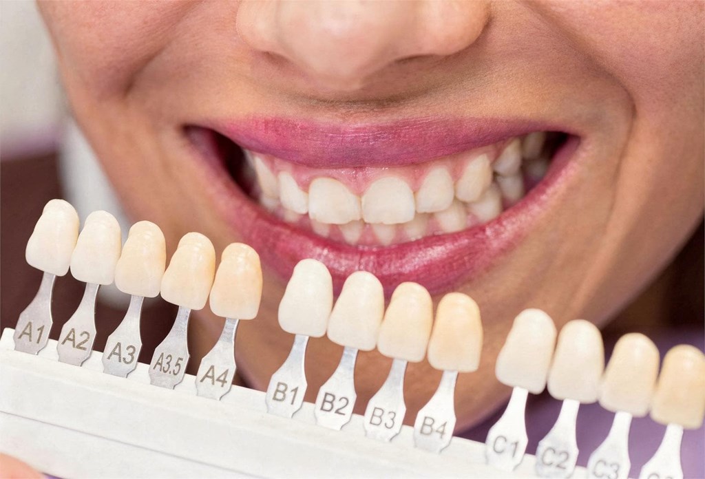 ¿Se pueden amarillear las carillas dentales por malos hábitos?