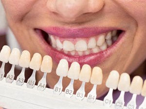 ¿Se pueden amarillear las carillas dentales por malos hábitos?